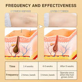 IPL Laser Hair Removal Device - Painless and Safe for All Skin Types, Perfect for Home Use